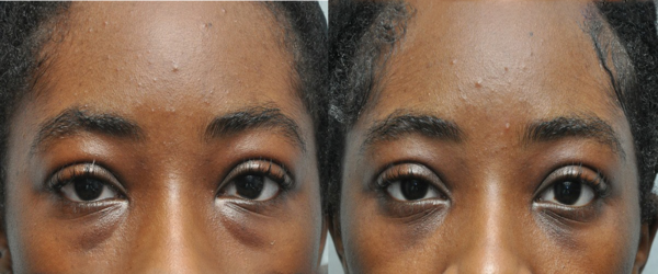 VShell ANTI-AGEING eye and Face cream